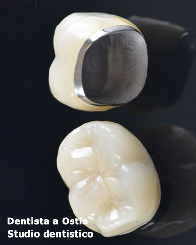 dentista-Ostia-corona-metallo-ceramica