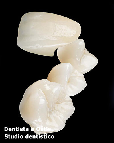 dentista-Ostia-corone-in-zirconio