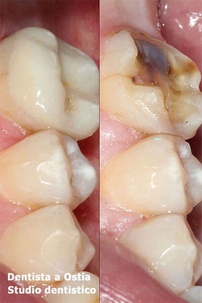 dentista-Ostia-carie-devitalizzazione-cura-canalare-dente
