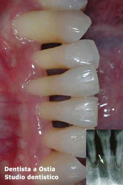 dentista-Ostia-cura-malattia-parodontale-piorrea