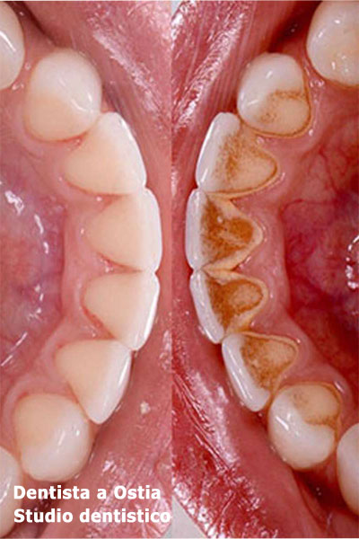 dentista-Ostia-igiene-dentale-ablazione-del-tartaro