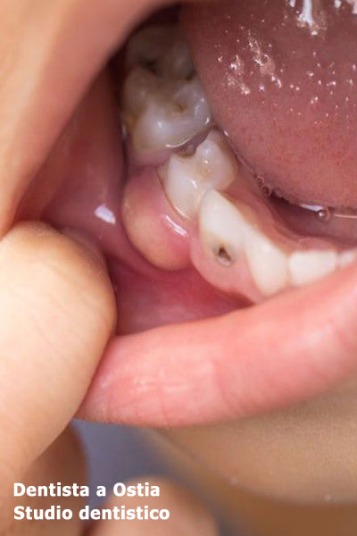 dentista-Ostia-prevenzione-cure-gengivali