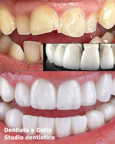 dentista-Ostia-estetica-dentale-corone-in-zirconio