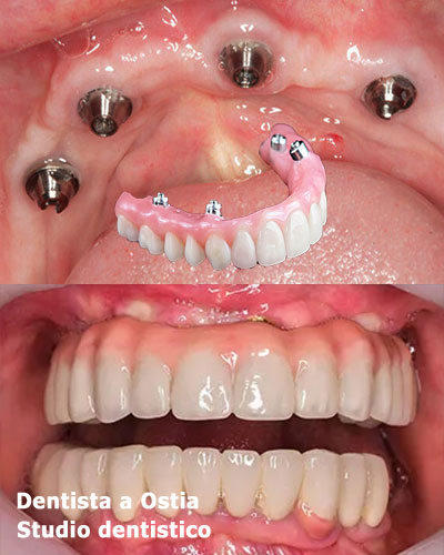 dentista-Ostia-estetica-dentale-all-on-four