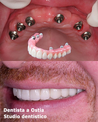 dentista-Ostia-estetica-dentale-all-on-six
