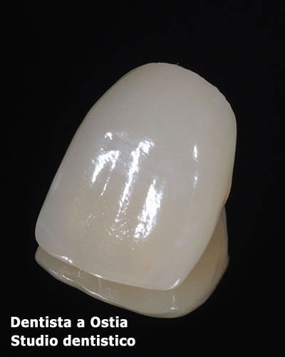 dentista-Ostia-faccette-dentali