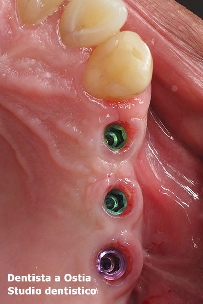 dentista-Ostia-impianti-dentali-premolari-molari