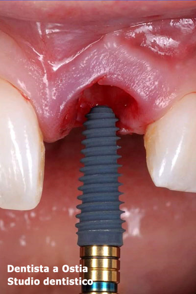 dentista-Ostia-impianto-dentale