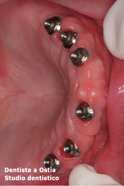 dentista-Ostia-protocollo-con-impianti-dentali-all-on-six