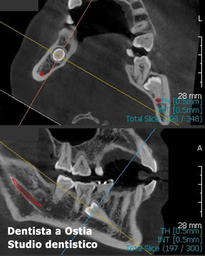 dentista-Ostia-tac-3d