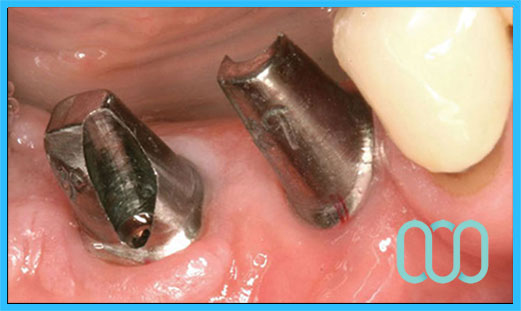 dentista-per-estetica-dentale-Grosseto prezzi 20