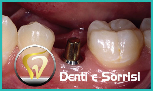 Dentista-per-estetica-dentale-a-Forlì 22