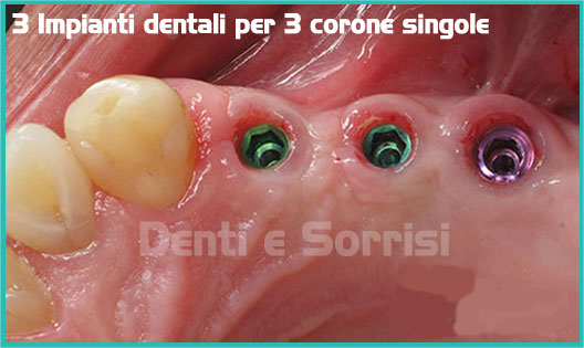 3-Impianti-dentali-per-3-corone-singole