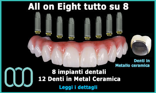 all-on-Eight-tutto-su-8-denti-in-metallo-ceramica-prezzo