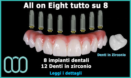 all-on-Eight-tutto-su-8-prezzo-standard-zirconio