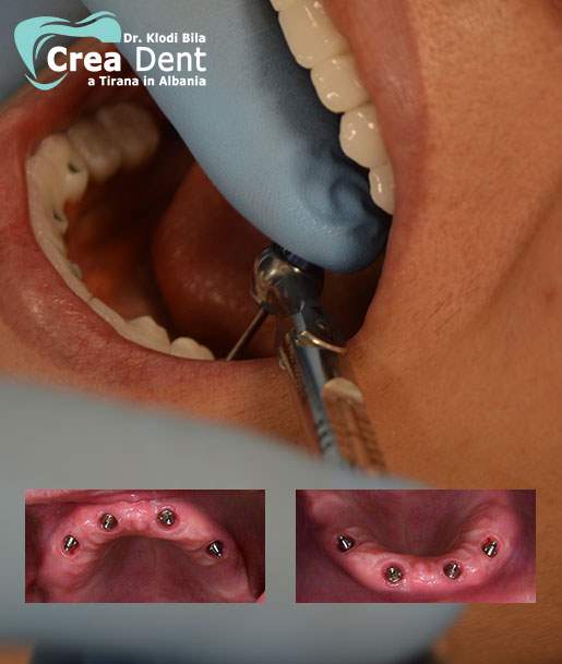 all-on-four-4-impianti-dentali-per-arcata