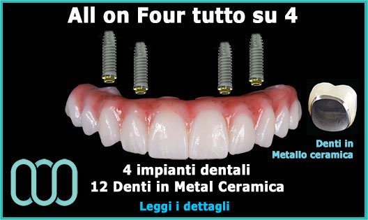 all-on-four-tutto-su-4-denti-in-metallo-ceramica-prezzo