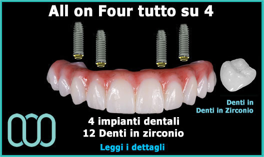 all-on-four-tutto-su-4-denti-in-zirconio-prezzo