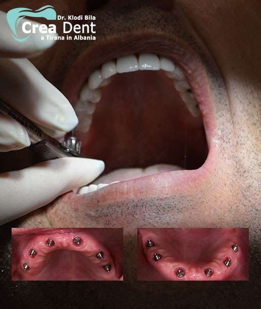 all-on-six-6-impianti-dentali-per-arcata