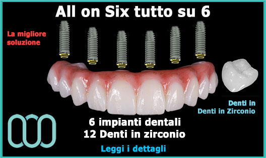 all-on-six-tutto-su-6-prezzo-economy-zirconio