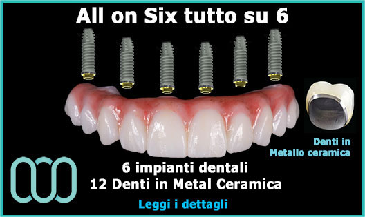 all-on-six-tutto-su-6-denti-in-metallo-ceramica-prezzo