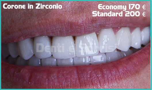 denti-in-zirconio-tirana-albania
