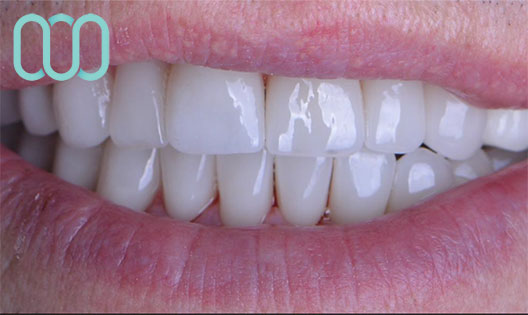 denti-in-zirconio-tirana-albania