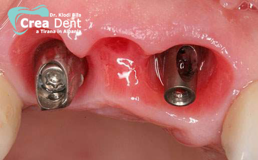 due-impianti-dentali-per-posizione-denti