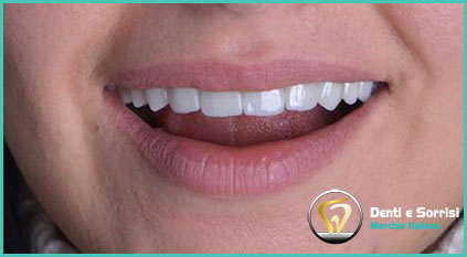 estetica-dentale-con-corone-in-zirconio-donna-2-tirana-albania
