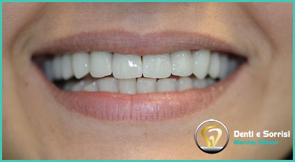 estetica-dentale-con-corone-in-zirconio-donna-tirana-albania
