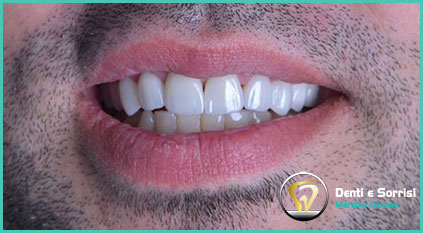 estetica-dentale-con-corone-in-zirconio-uomo-2-tirana-albania
