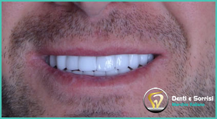 estetica-dentale-con-corone-in-zirconio-uomo-tirana-albania