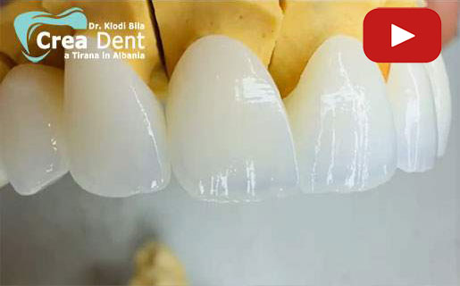 estetica-dentale-con-corone-in-zirconio