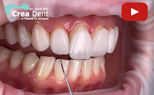 faccette-dentali-emax-o-zirconio