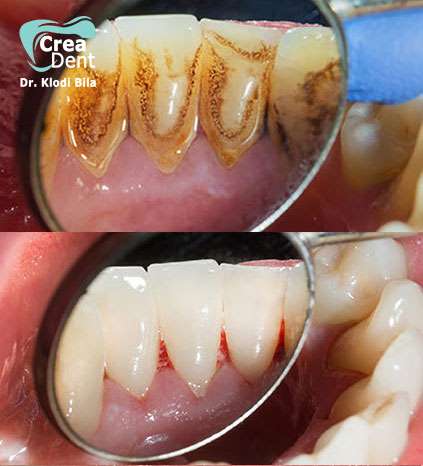 igiene-air-flow-per-eliminare-il-tartaro