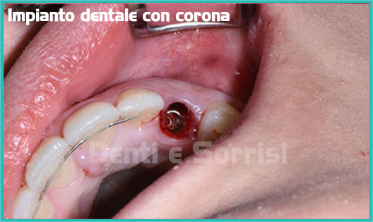 impianto-dentale-con-corona