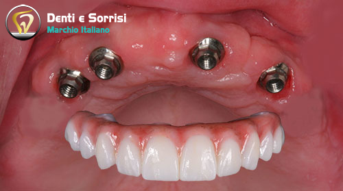 implantologia-di-4-impianti-dentali-all-on-four