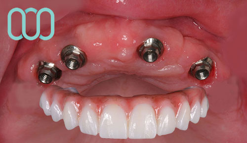 implantologia-di-4-impianti-dentali-all-on-four