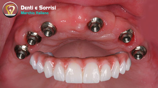 implantologia-di-6-impianti-dentali-all-on-six