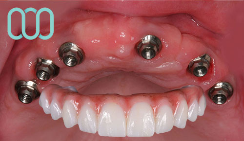 implantologia-di-6-impianti-dentali-all-on-six