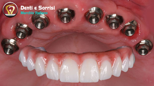 implantologia-di-8-impianti-dentali-all-on-eight