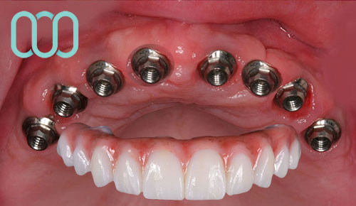 implantologia-di-8-impianti-dentali-all-on-eight