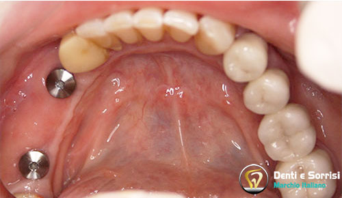 implantologia-di-due-impianti-dentali