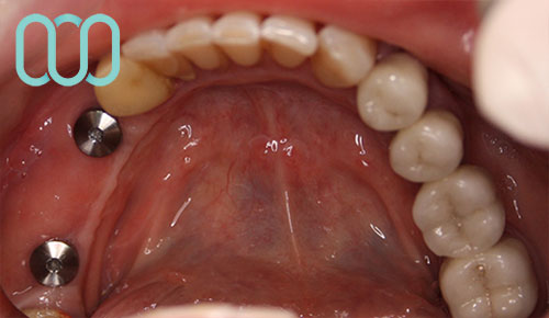 implantologia-di-due-impianti-dentali