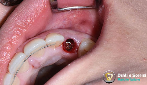 implantologia-di-un-impianto-dentale