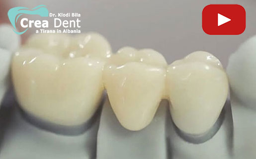 ponti-in-zirconio-di-3-4-denti