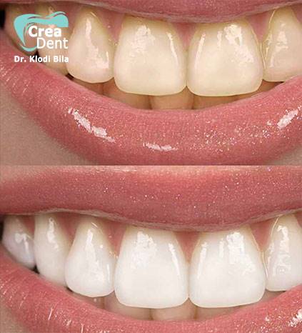 sbiancamento-dentale
