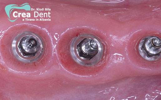 tre-impianti-dentali-per-posizione-denti