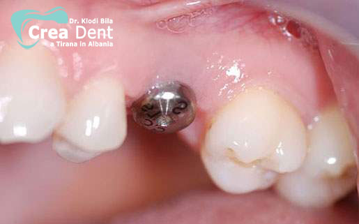 un-impianto-dentale-per-posizione-dente