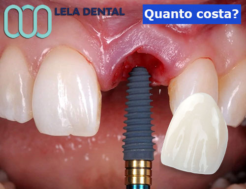 impianto-dentale-con-dente-in-zirconio